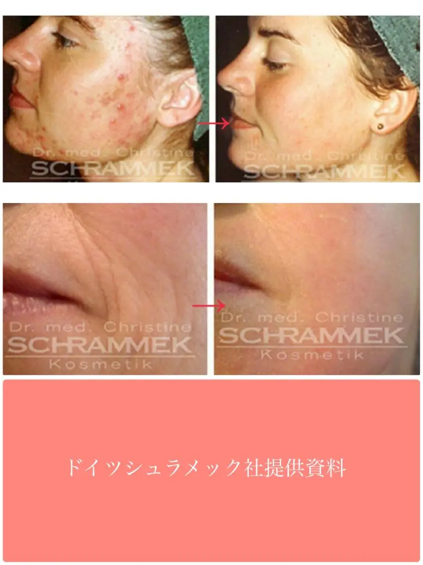 ドイツのエステ☆美容外科、皮膚科でも大人気☆グリーンピール５５SECの写真