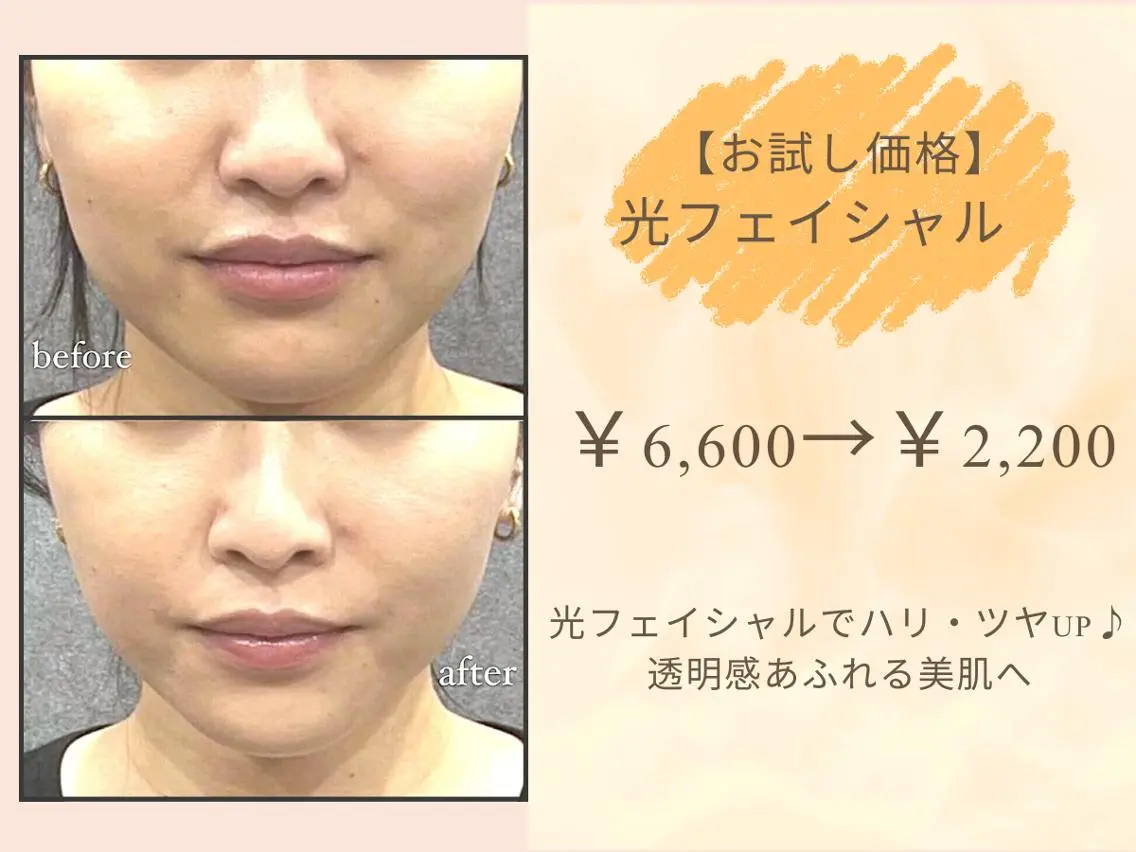 【お試し価格】光フェイシャル　通常￥6,600→￥2,200の写真