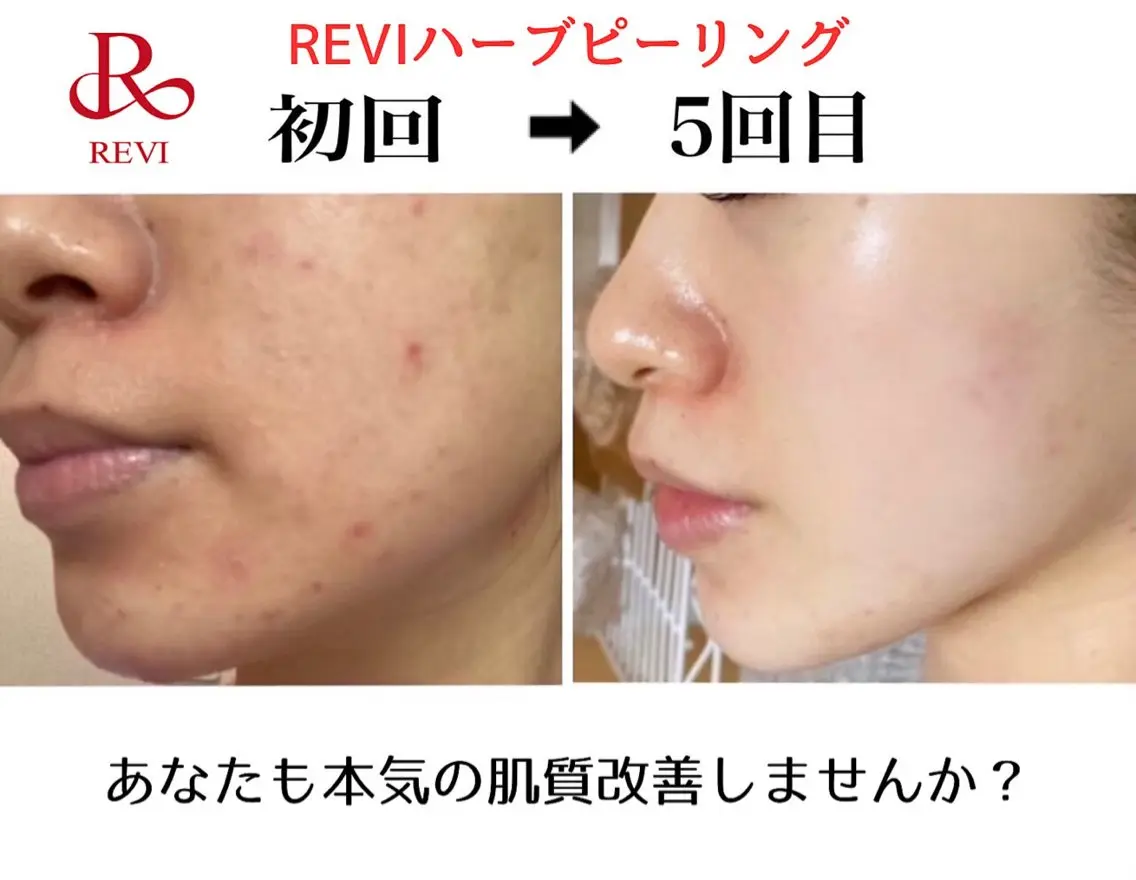 エステ ハーブピーリング専門 毛穴洗浄❤️眉waxのエステ・リラクイメージ