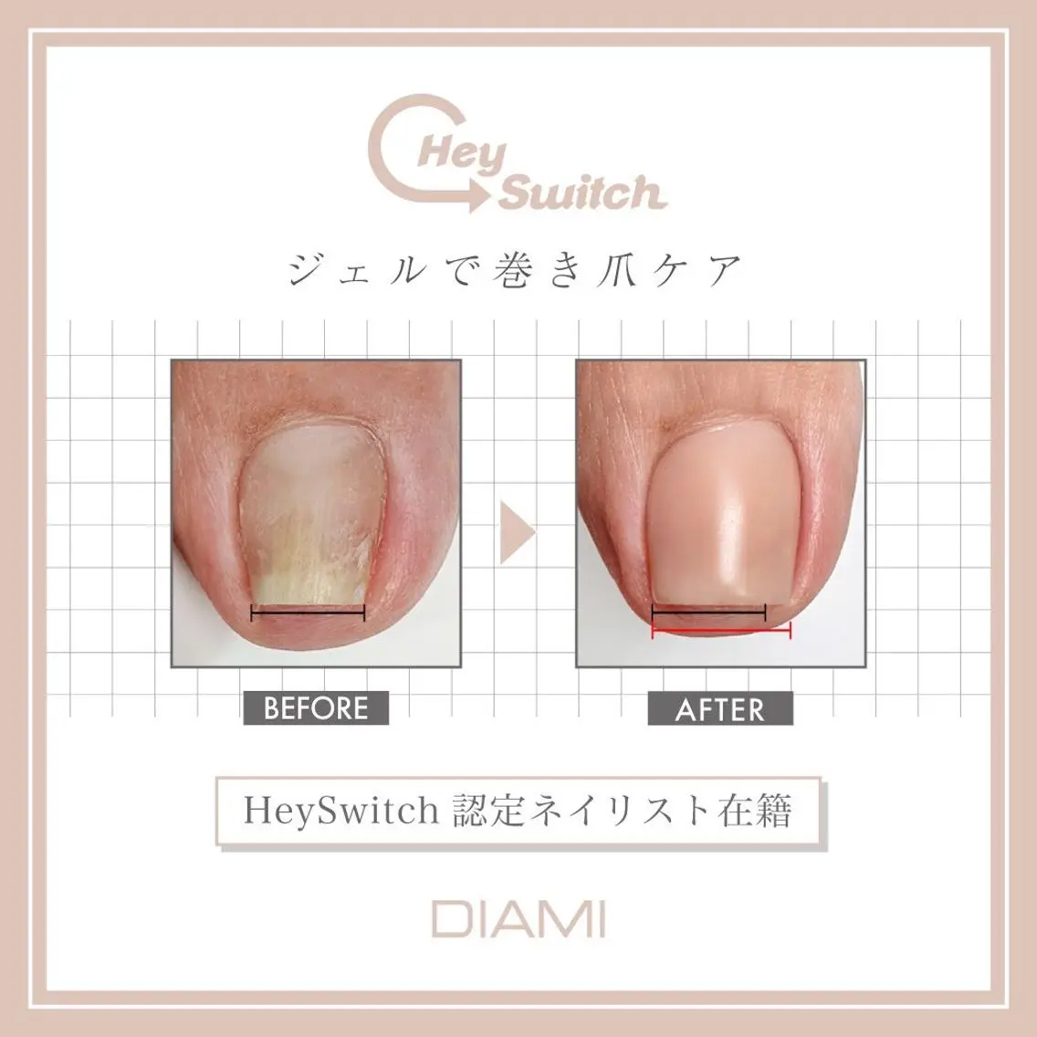 巻き爪ケア2本【Hey Switch】の写真
