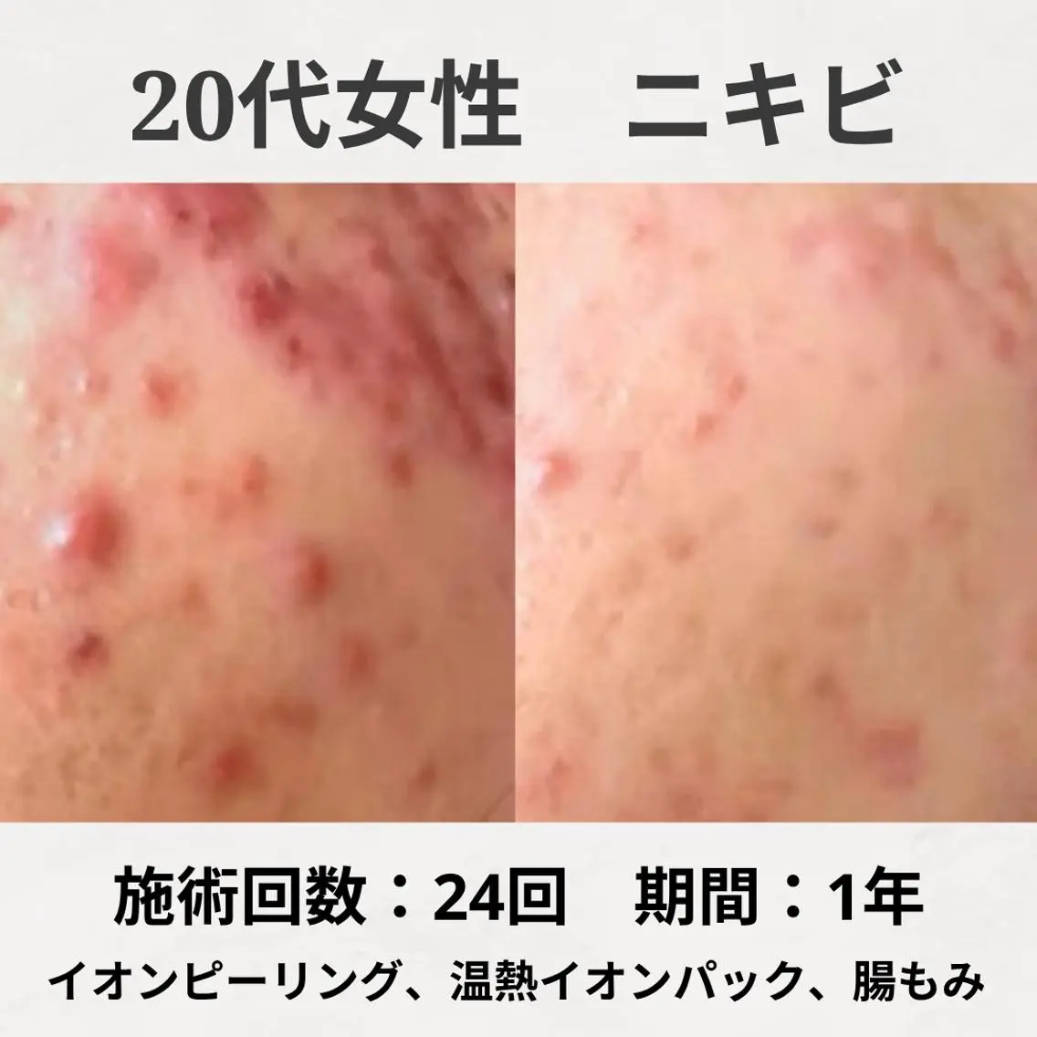 エステ リラク ニキビ跡改善専門🔥 医療にはできない改善のエステ・リラクイメージ