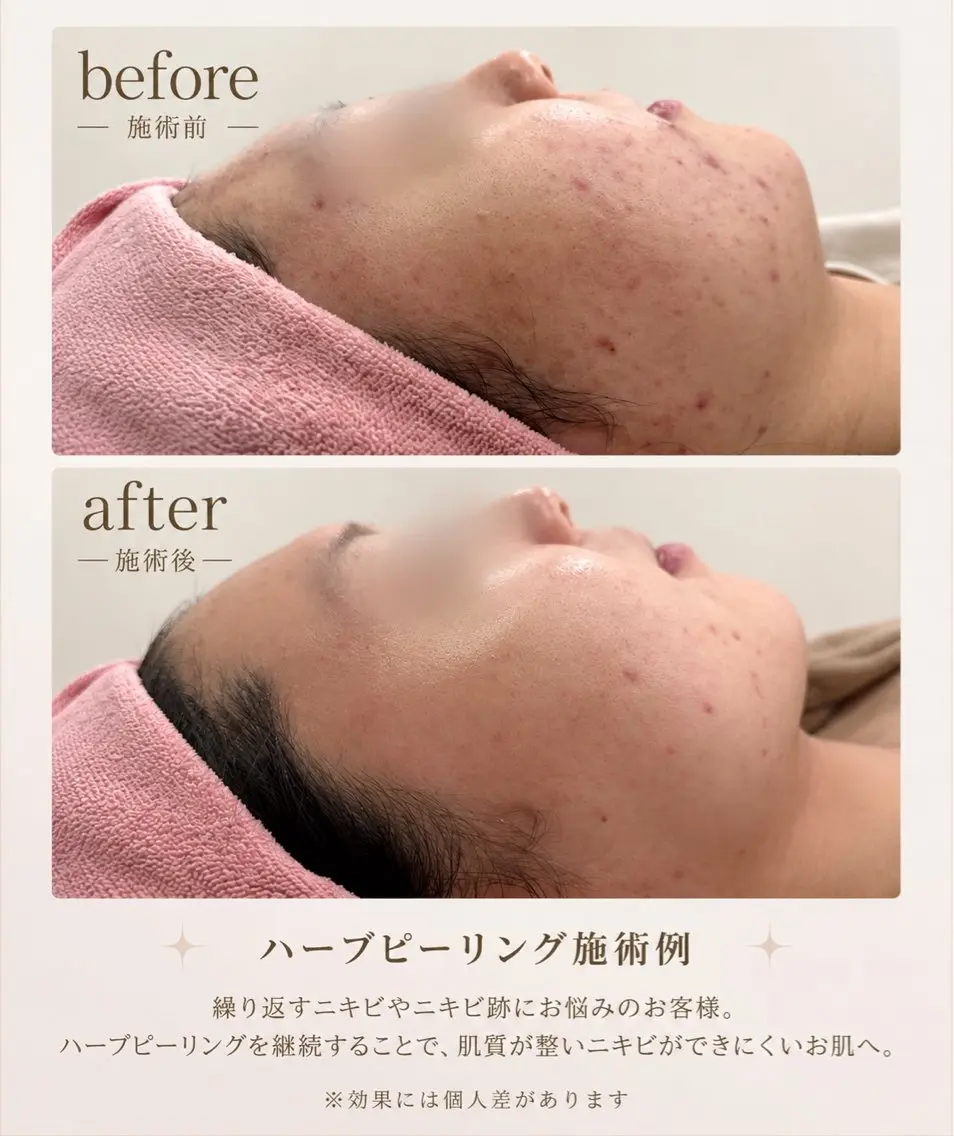 【メニューにお悩みの方はこちら♪】お悩みに合わせて最適な施術をご案内◎の写真