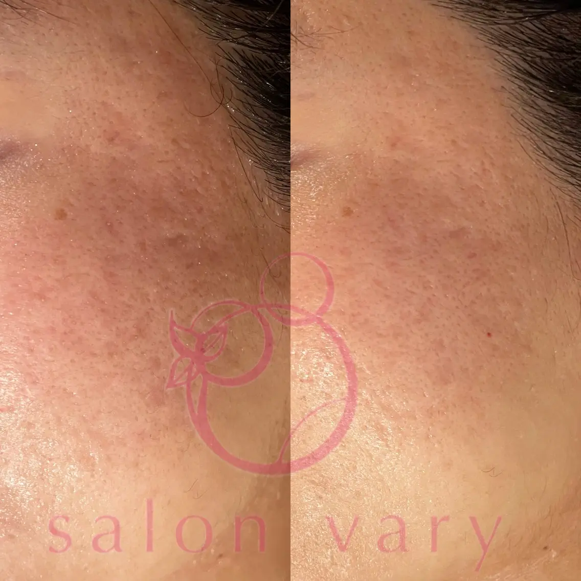 ニキビ•ニキビ跡改善 salon varyのエステ・リラクイメージ