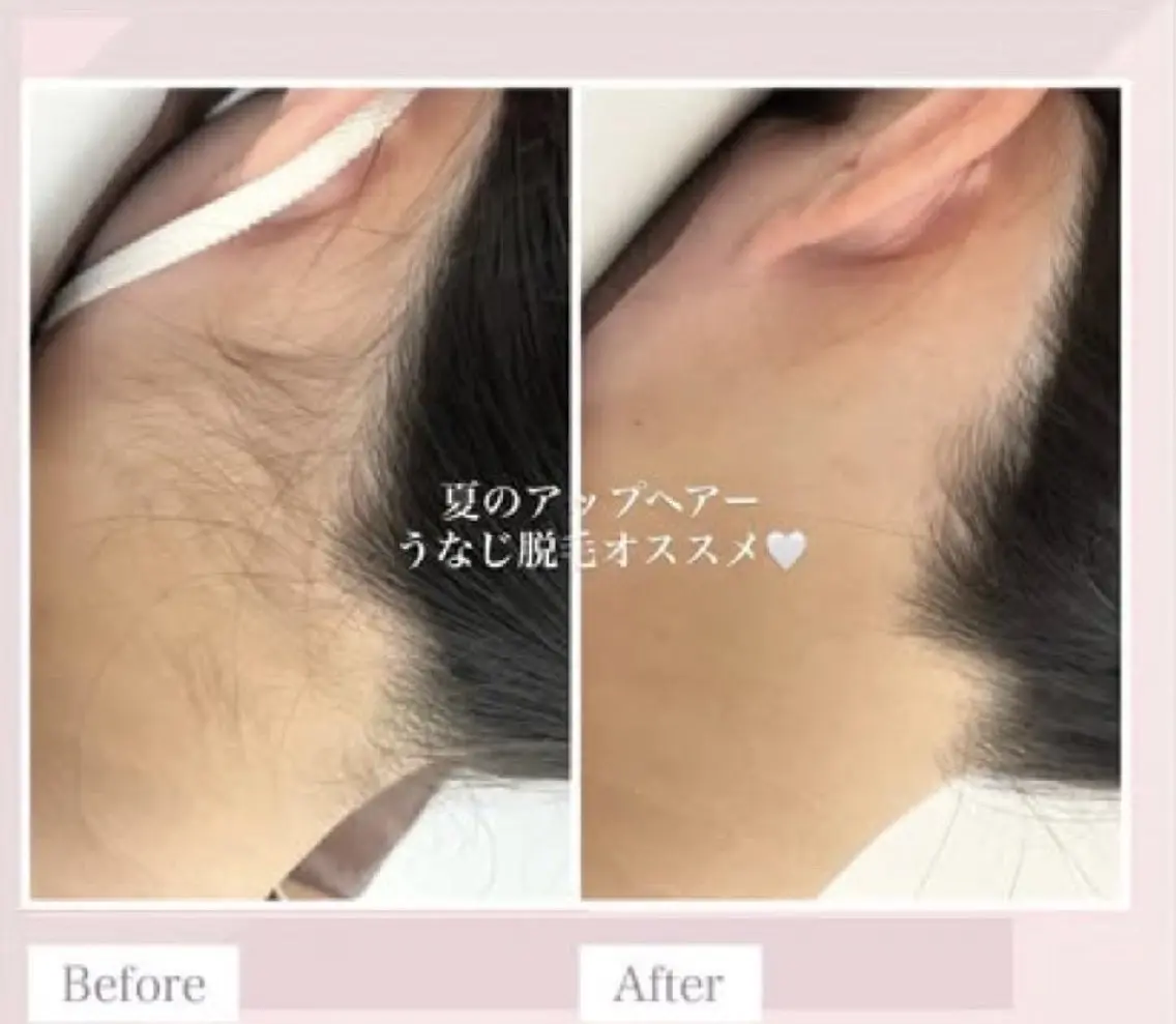 【うなじ脱毛+デザインシェービング付】¥2000　ポニーテール/アップヘアに◎丁寧にデザインします😊の写真