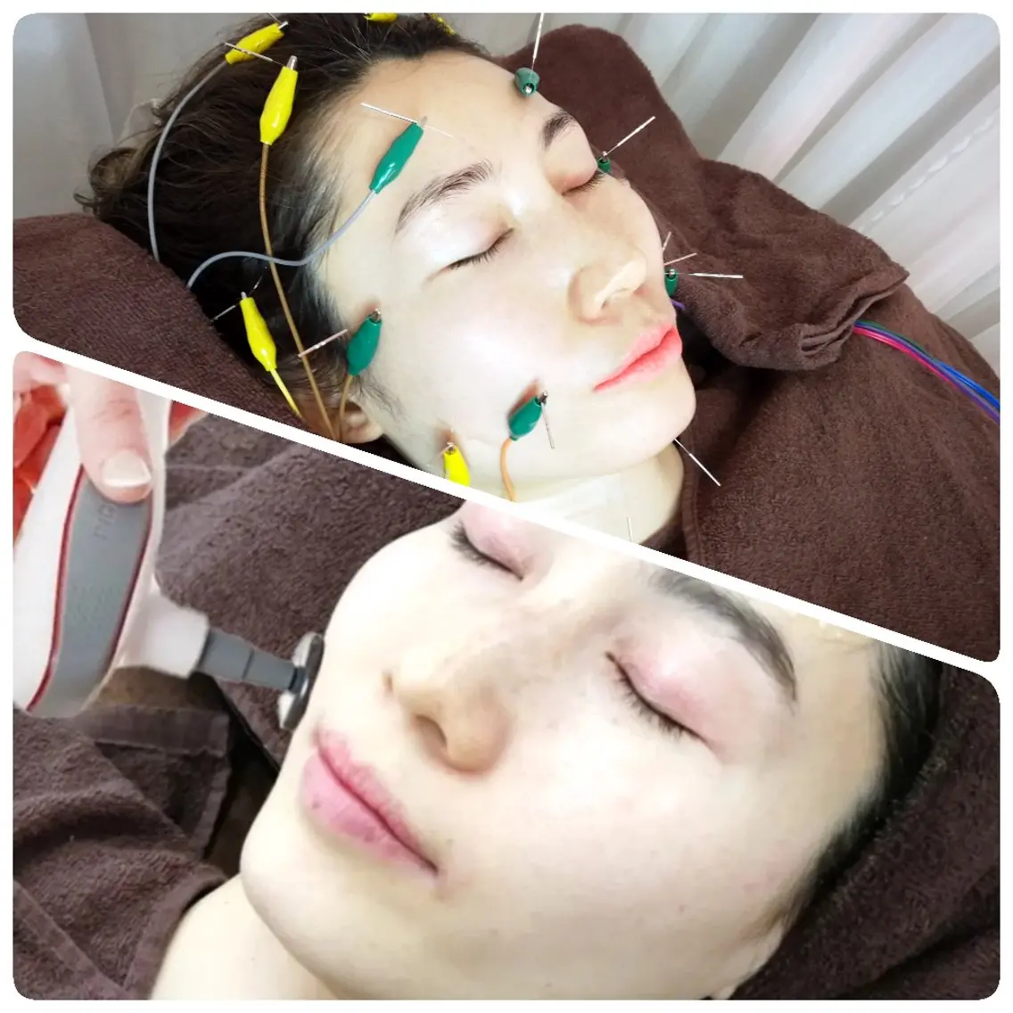 【とにかく小顔・むくみ・エラ】ラジオ波フェイシャル🔥+20ヶ所電気美容鍼⚡🪡【ニューハーフ鍼灸師の最強肌管理🌹】の写真
