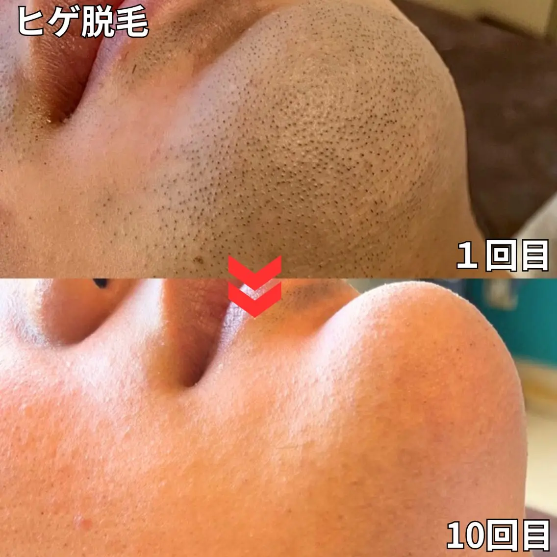 【平日限定50%オフ✨】ヒゲ全部脱毛の写真