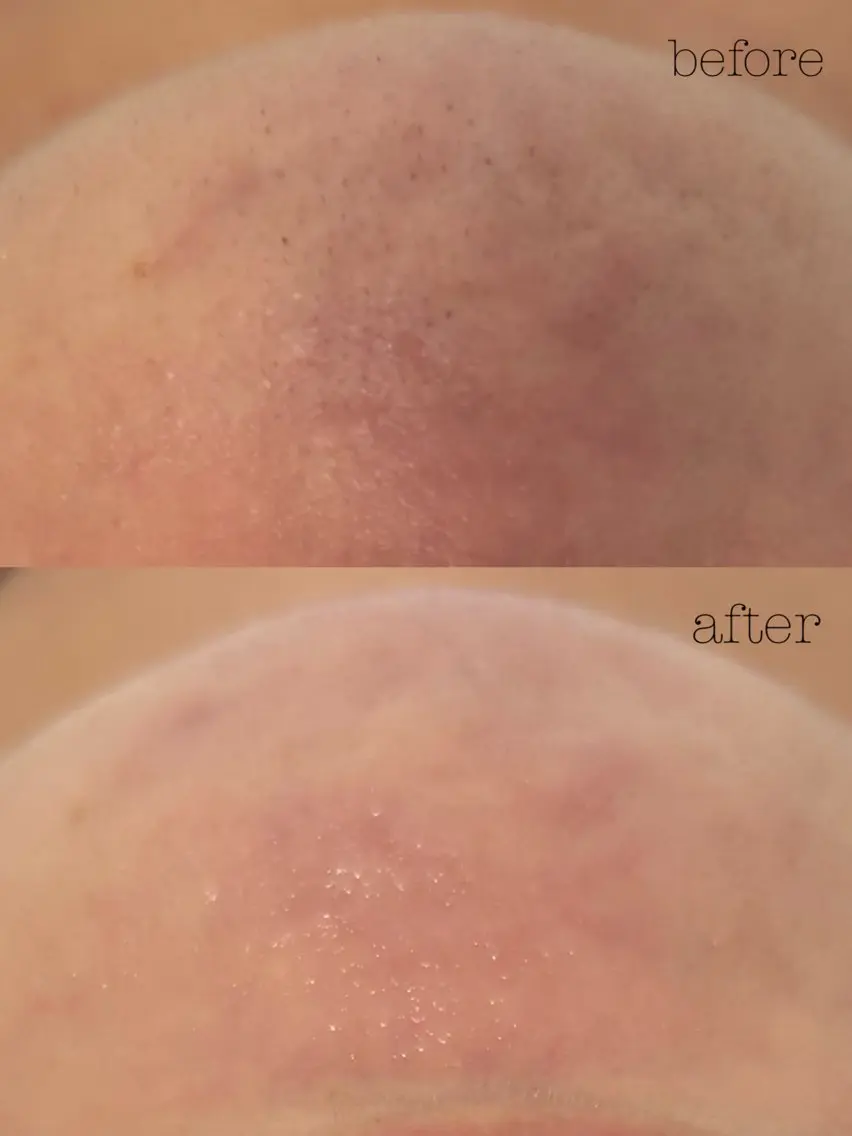 フェイシャルWax脱毛✨全顔の写真