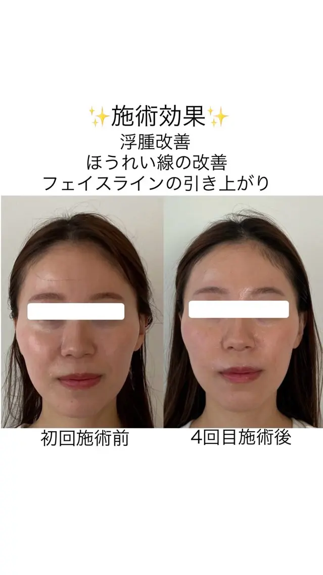 全身整体＋小顔矯正＋美容鍼の写真
