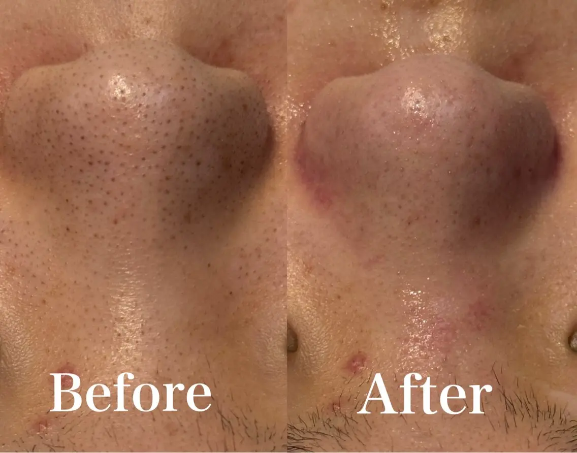 【先着3名限定！】毛穴洗浄体験🫧ツヤツヤお肌になりたい方にオススメ🧖🏻‍♀️🩵の写真