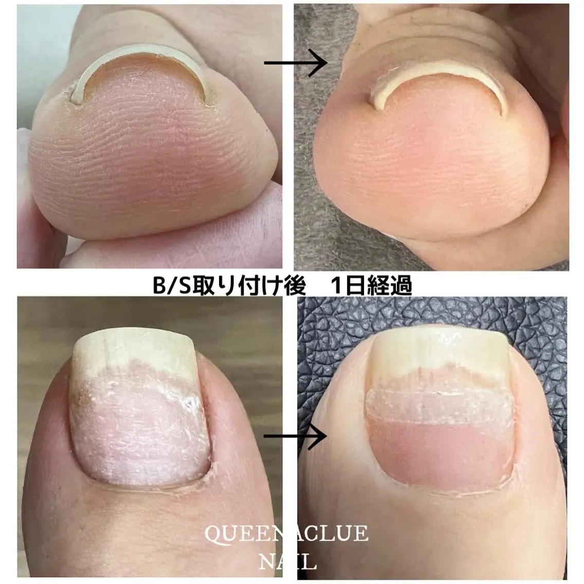 巻き爪改善(ケア込み) ￥6000の写真