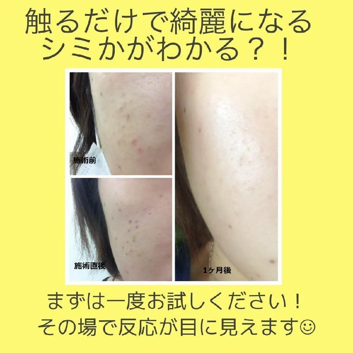 ⭐期間限定⭐シミケアプレミアムコースの写真