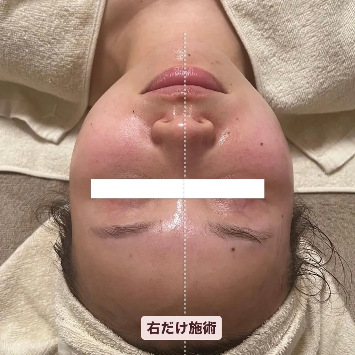 EMS小顔リフトコース🫧 痛みのないリフトアップコース✨️ 半額体験で左右の比較を見ていただけます🕊️の写真