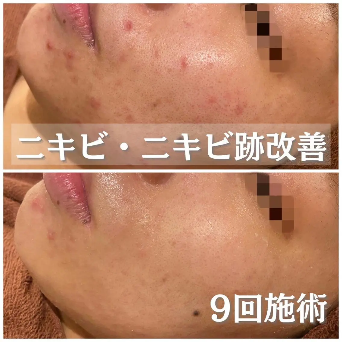 ミディアム カラー パーマ ヘアアレンジ メンズ キッズ ネイル マツエク・マツパ アイブロウ 3か月で肌革命👼 ニキビ専門店💫のエステ・リラクイメージ