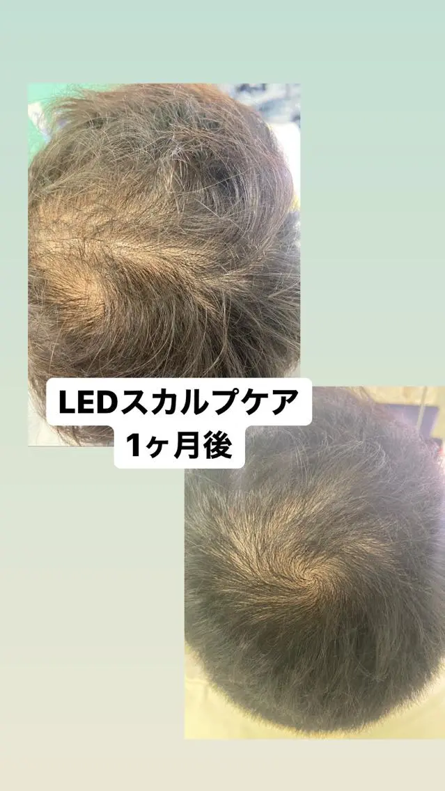 【初回限定】薄毛にお悩みの方、将来の為に薄毛予防をしたい方必見❣️驚くほど生えます❣️の写真
