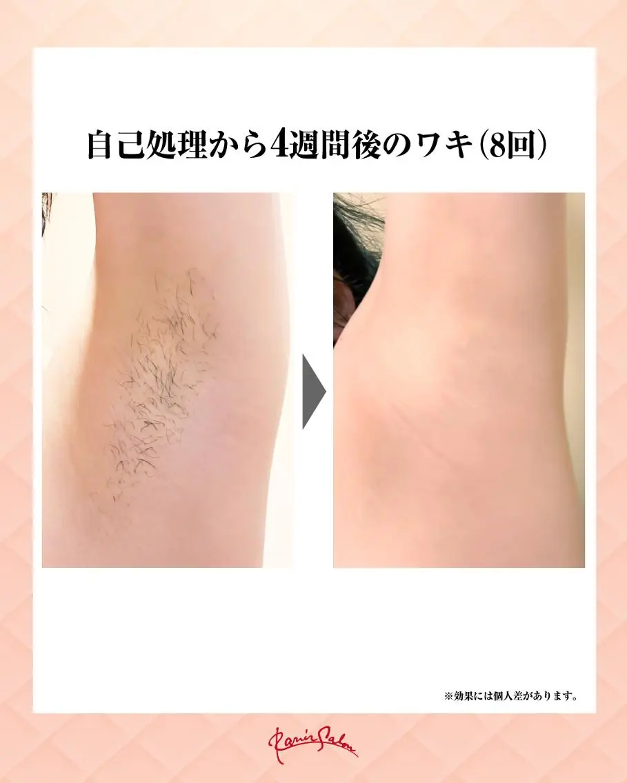お試し🐚セルフ脱毛の写真