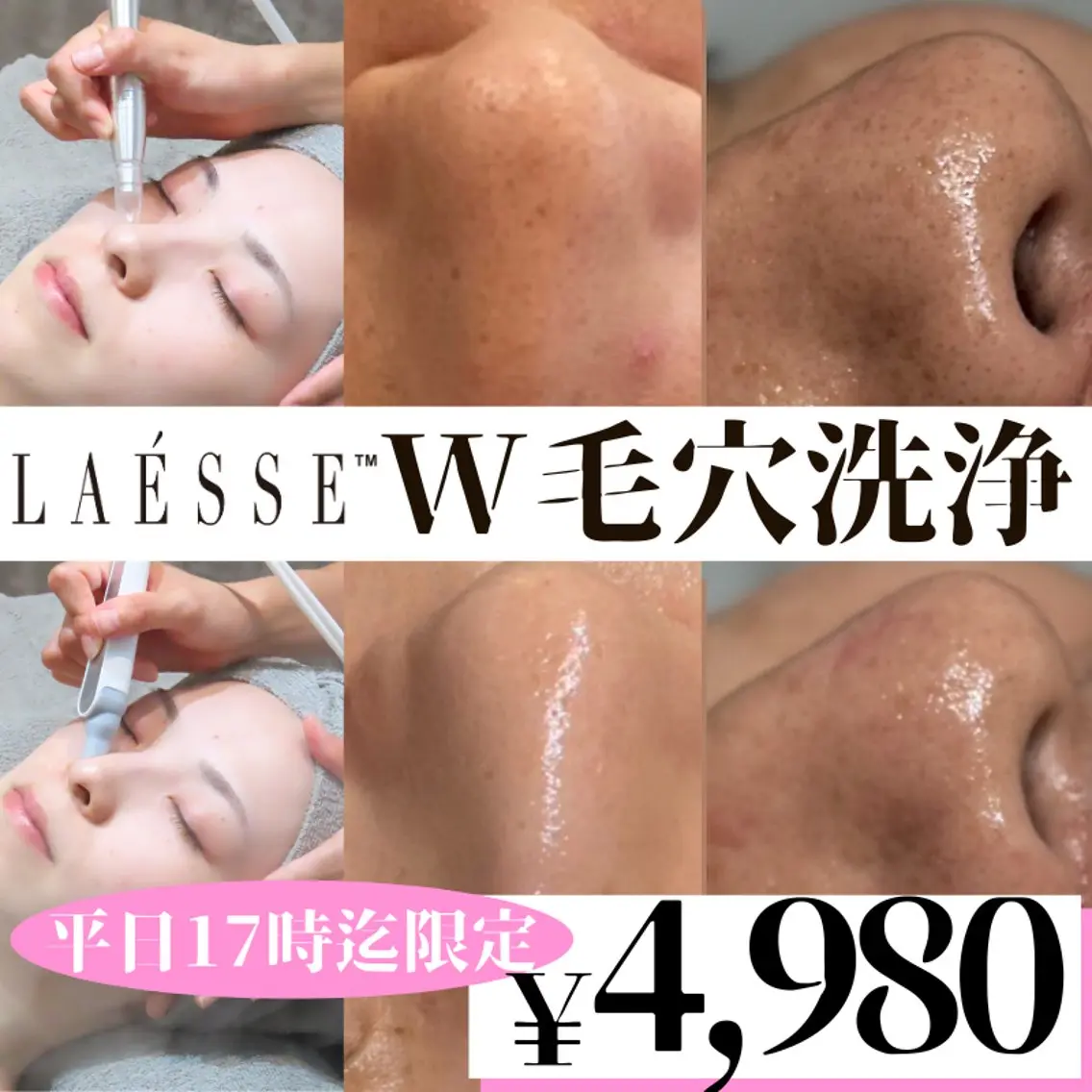 毛穴の黒ずみ・詰まりに！贅沢W毛穴洗浄🫧の写真