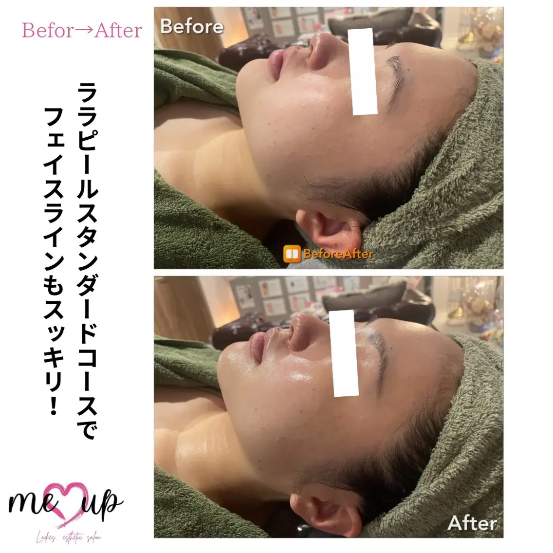 エステ Meupニキビ専門店 背中/ハーブ/肌管理のその他イメージ