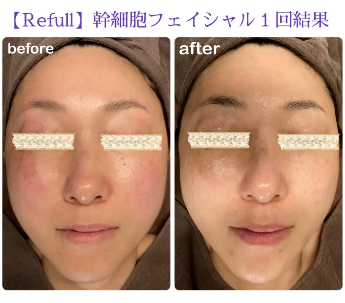 肌力UP✨フェイシャル75分(レストセルトリートメント)の写真