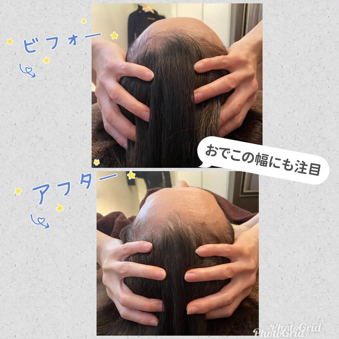 新規頭蓋骨小顔矯正60分の写真