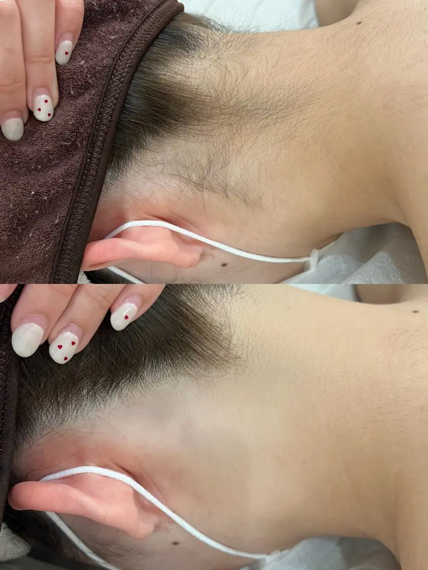 [綺麗な後ろ姿目指そう🦋]うなじ脱毛⭐️の写真