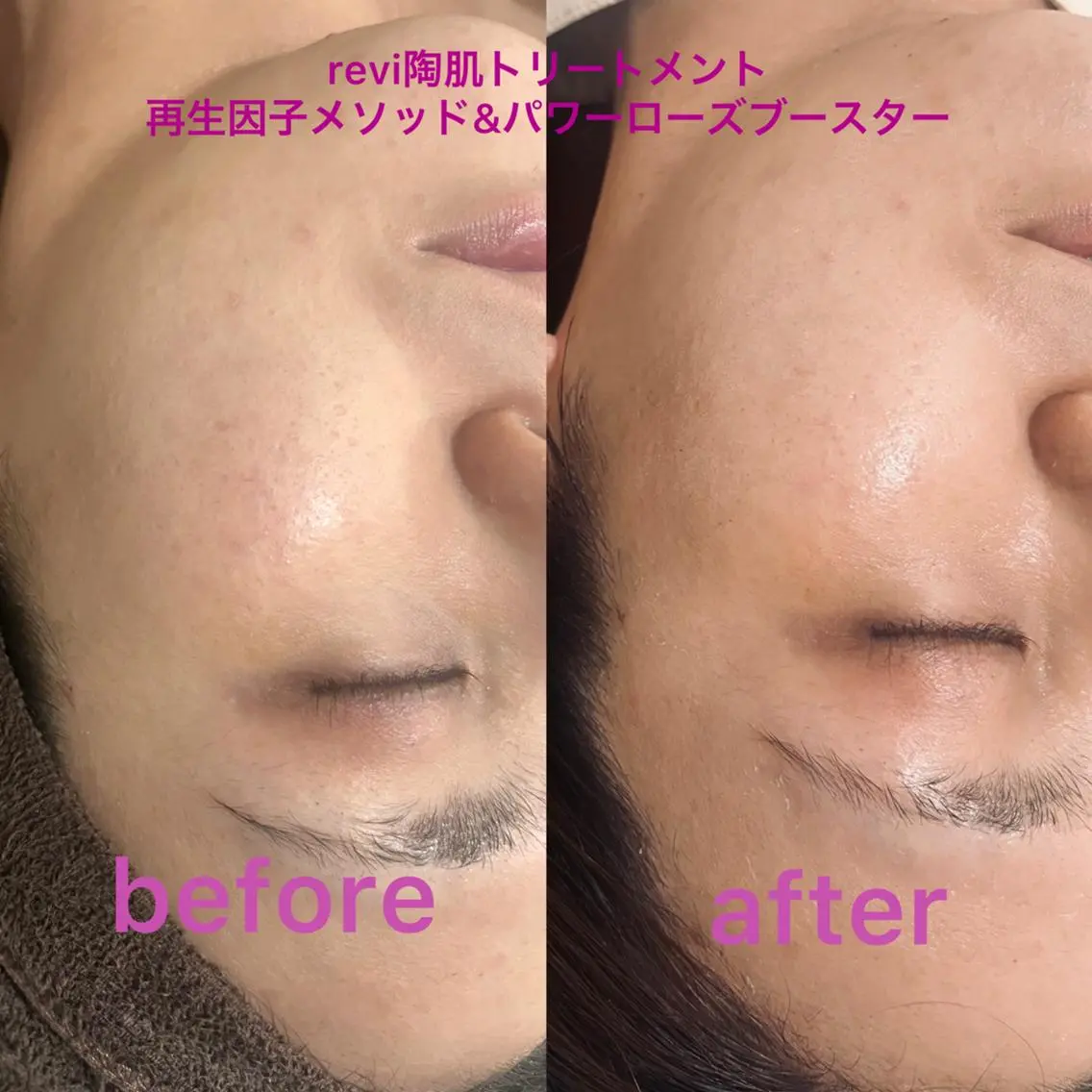 ミニモ限定 インスタなどで大注目!ハーブピーリング🌿【revi陶肌トリートメント2g】ドライヘッドスパ20分付♪の写真