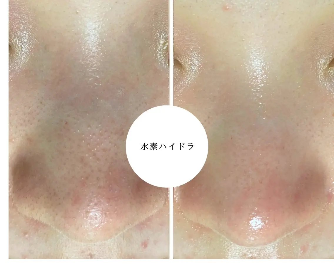 その他 水素ハイドラ/脱毛 /ハーブピーリングのその他イメージ