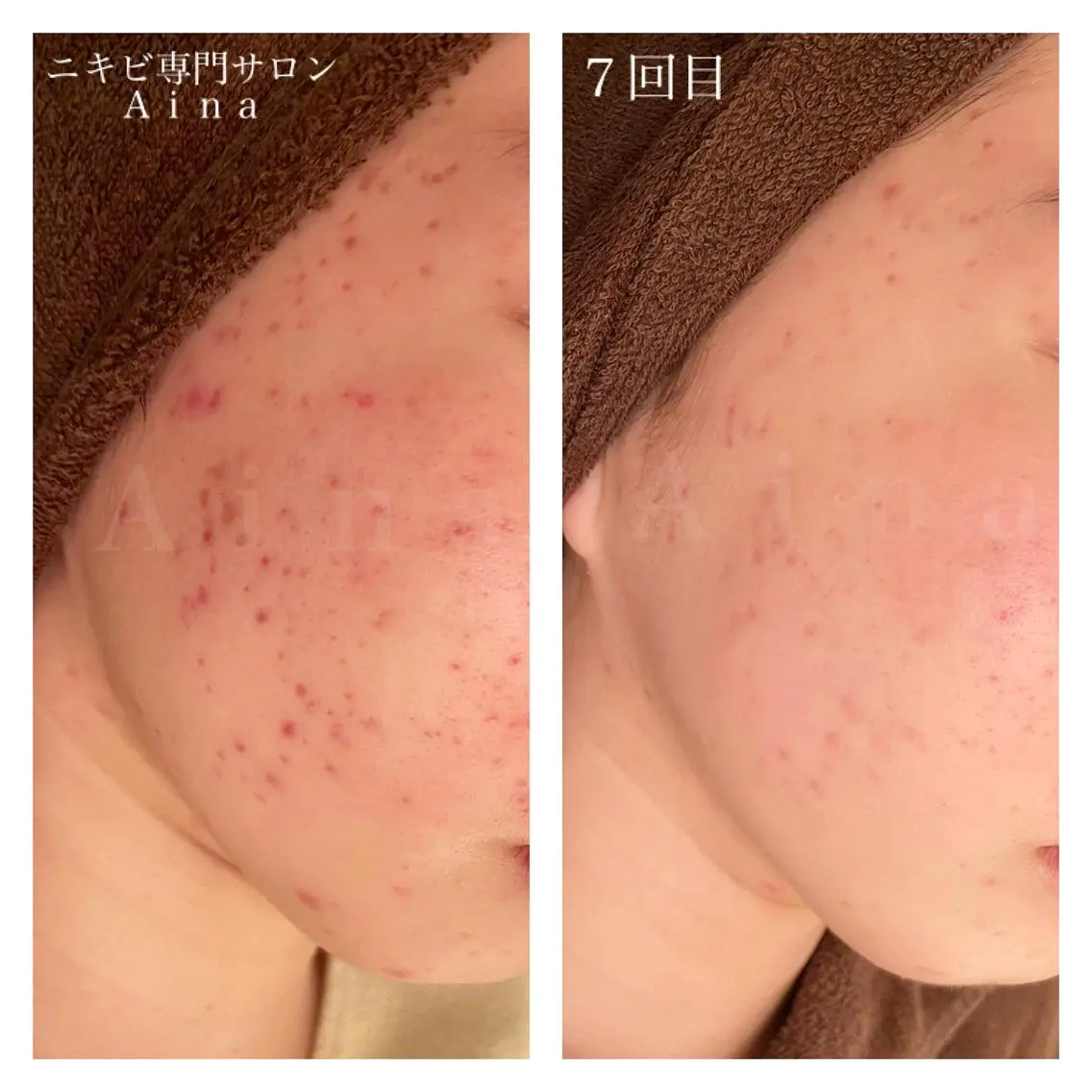 セミロング カラー パーマ ヘアアレンジ メンズ キッズ ネイル マツエク・マツパ 学生（メンズ向け） 学生 エステ リラク ニキビ跡専門サロン Ａｉｎａのエステ・リラクイメージ