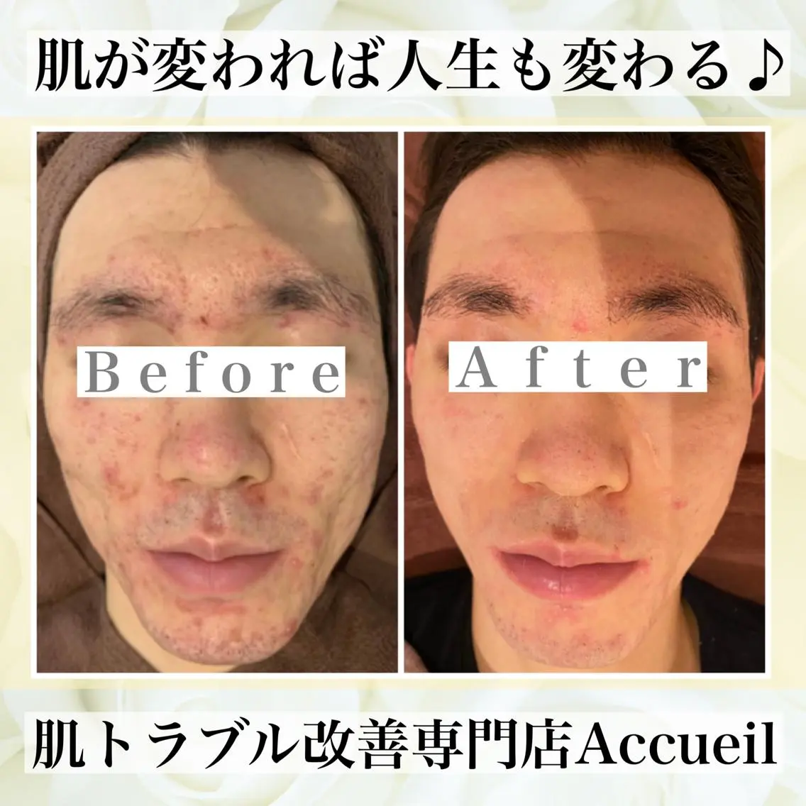 3か月で肌革命👼 ニキビ専門店💫のエステ・リラクイメージ