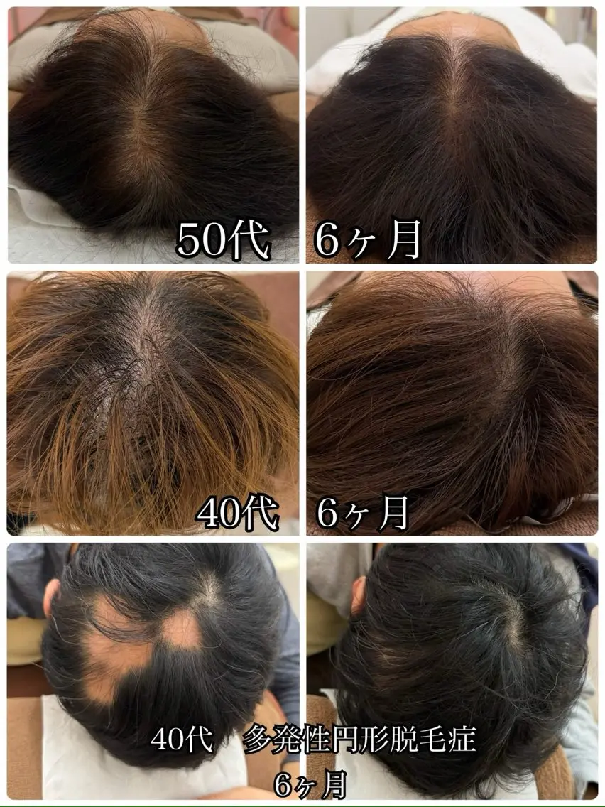 【初回体験価格】 鬼育毛促進鍼/抜け毛/薄毛/細毛/円形脱毛症¥27500→ ¥5980の写真