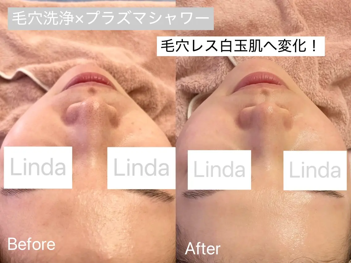 エステ 小顔&毛穴・肌質改善 LINDA西宮 AIのエステ・リラクイメージ