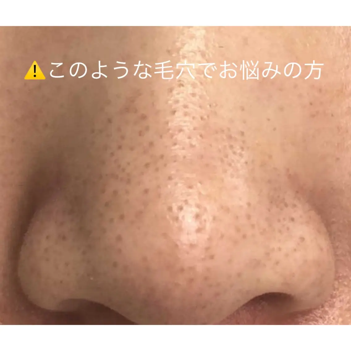 得！！角栓毛穴ケアニキビケア若々しい肌にソフトピーリングのハイドロスキン集中3回コースの写真