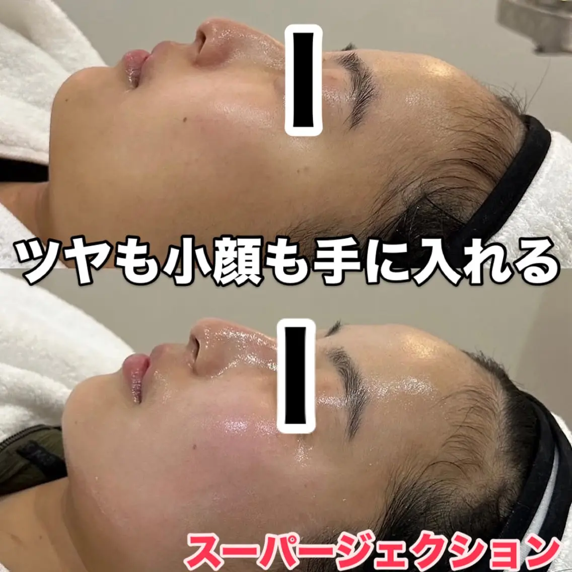 名古屋ではここでしかない🆕スーパージェクショントリートメントコース✨の写真