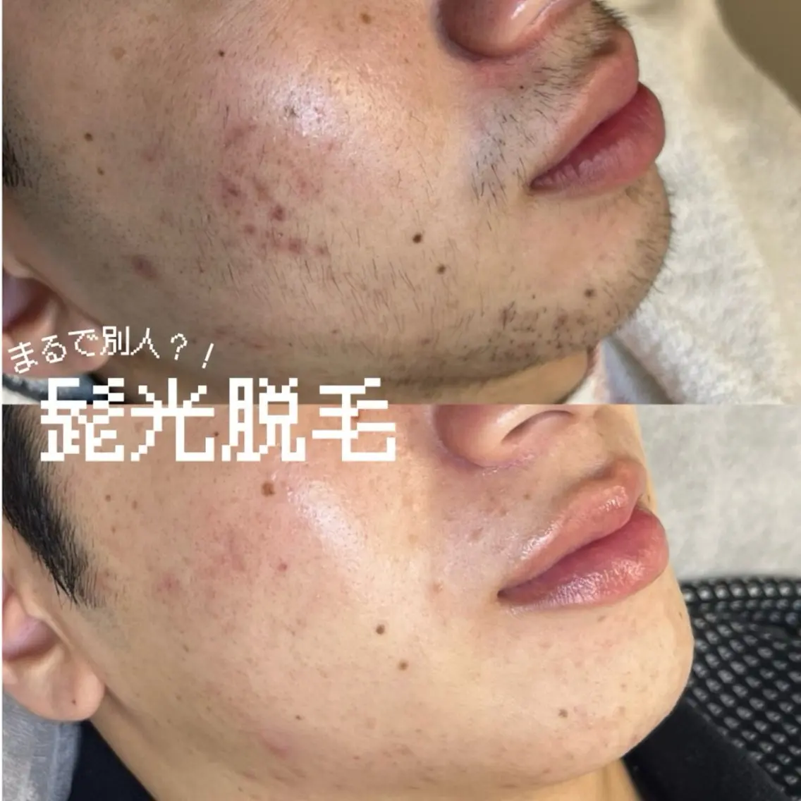 メンズ/ヒゲ全体光脱毛¥2,000🧔🏻🔥スキルアップレッスンモデル🆙の写真