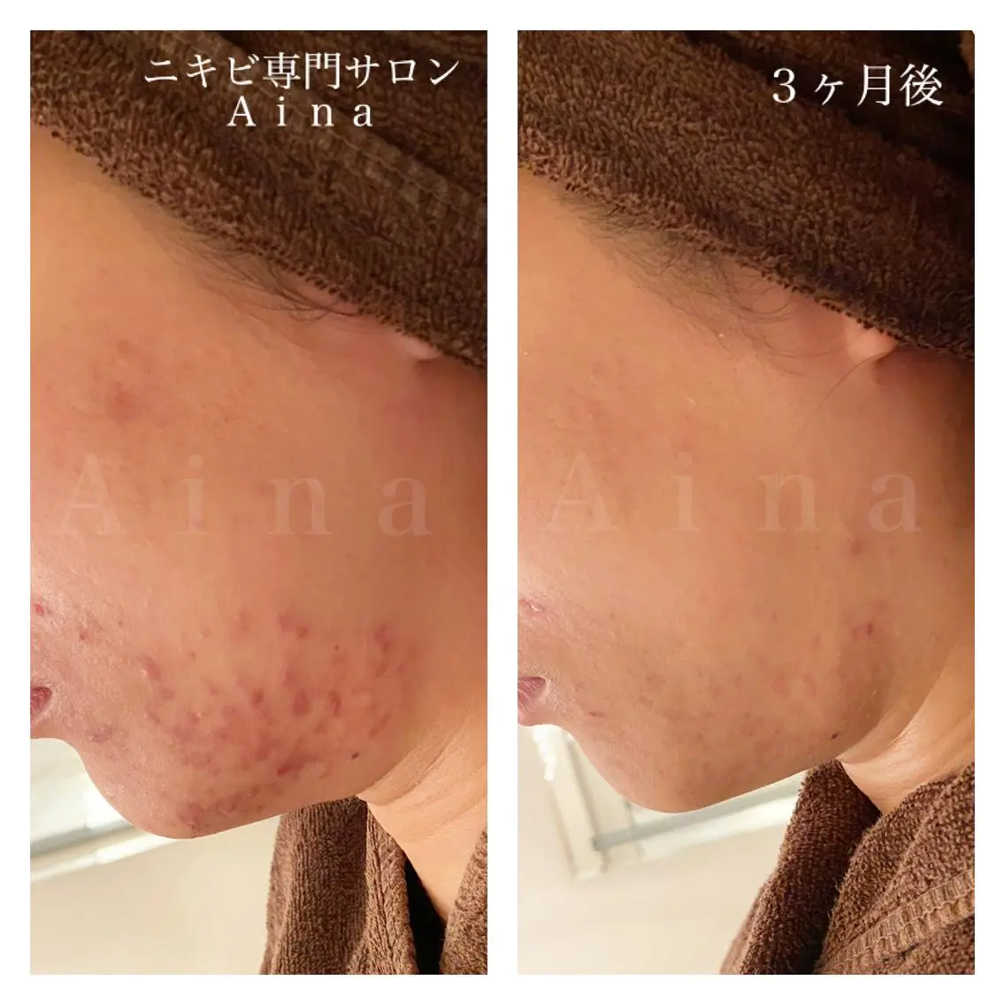 ミディアム カラー パーマ ヘアアレンジ メンズ キッズ ネイル マツエク・マツパ エステ リラク ニキビ跡専門サロン Ａｉｎａのエステ・リラクイメージ