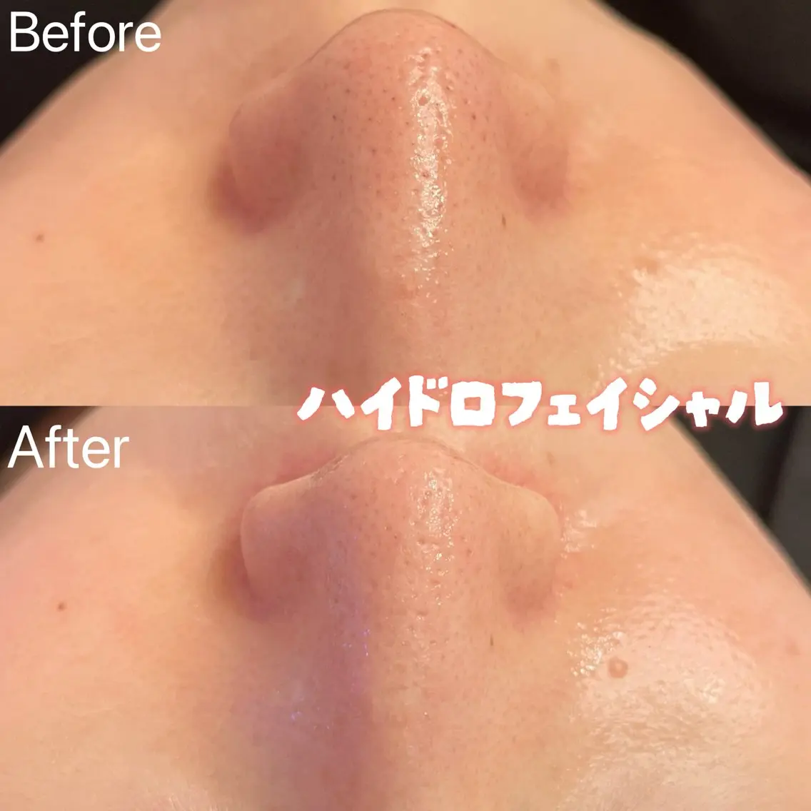 エステ 小顔&毛穴・肌質改善 LINDA西宮 AIのその他イメージ