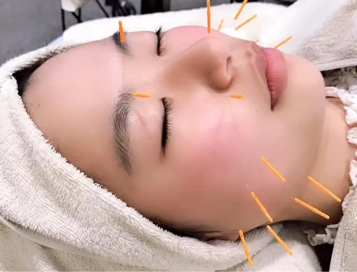 人気No. 2👑美容鍼➕潤肌パックの写真