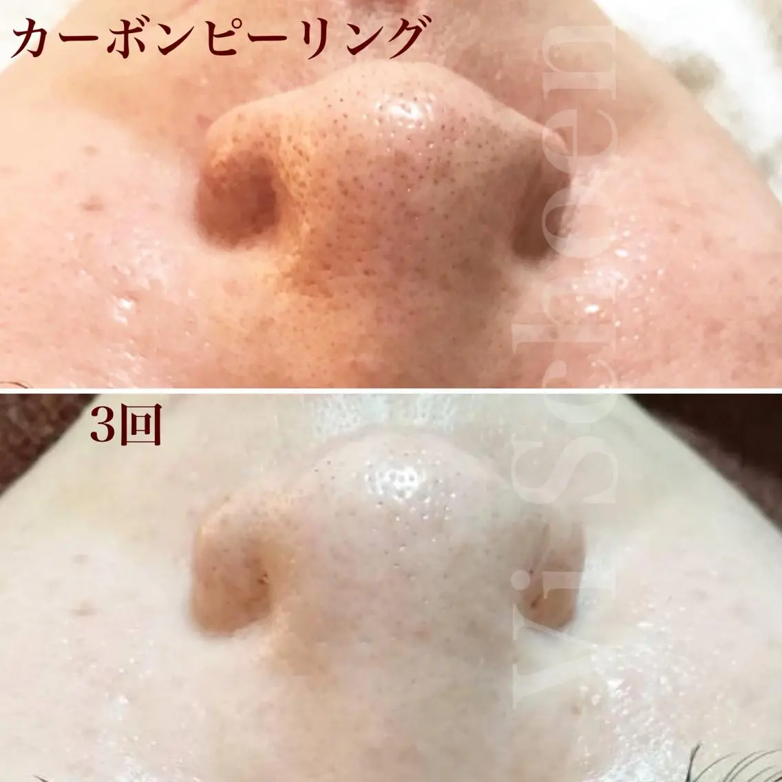 うなじ/もみあげ脱毛 ヴィシェーン佐藤のエステ・リラクイメージ