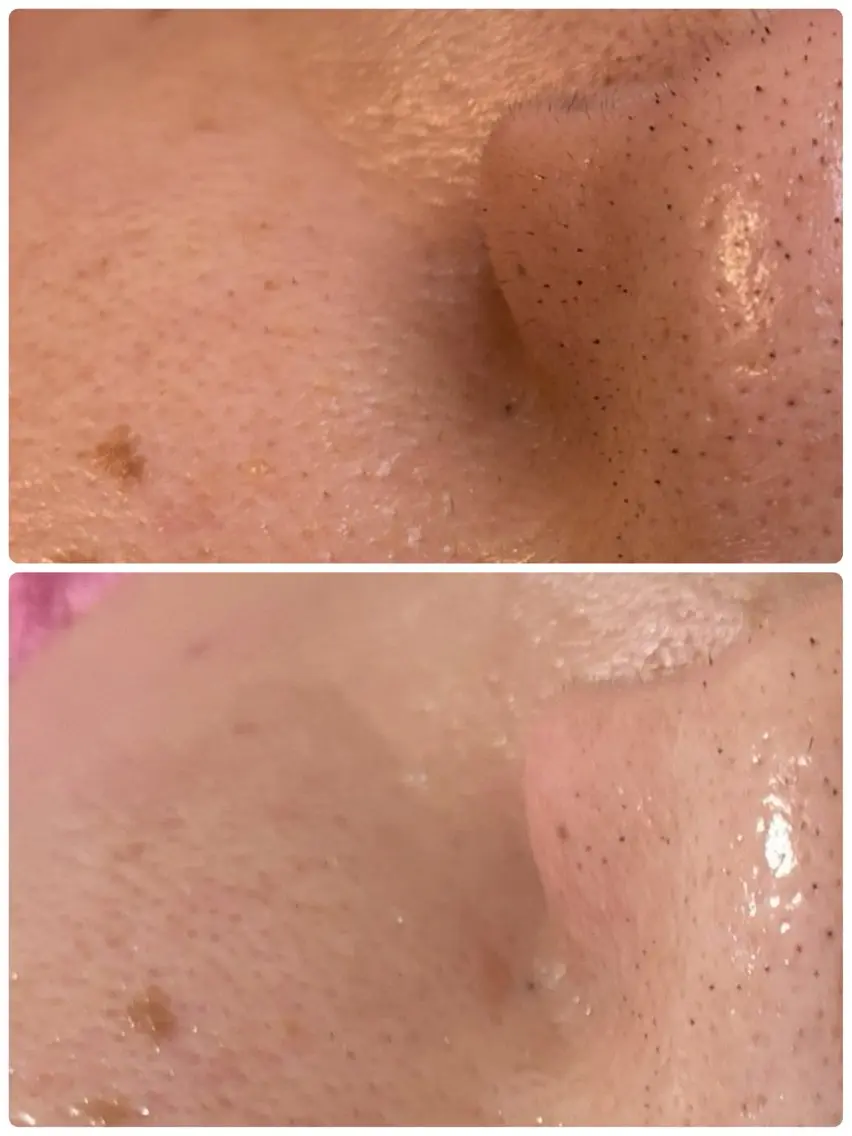 マツヤニホットセラピーWaxでお顔の産毛を取り、綺麗にしてツルツルに。の写真