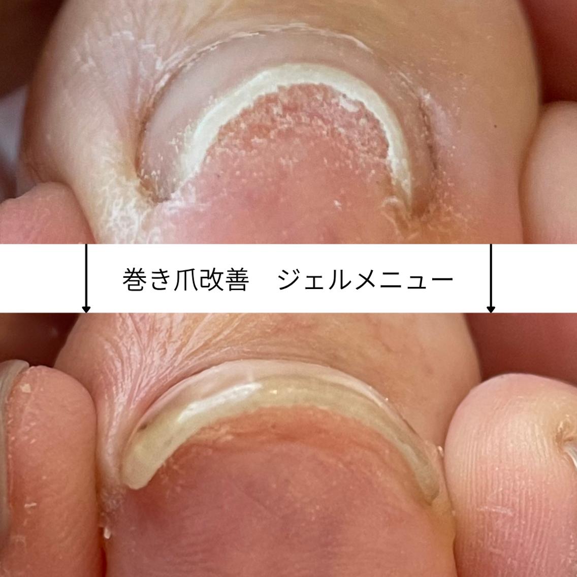 フットのお休み期間に! 【巻き爪改善ネイル】 親指2本¥2000の写真