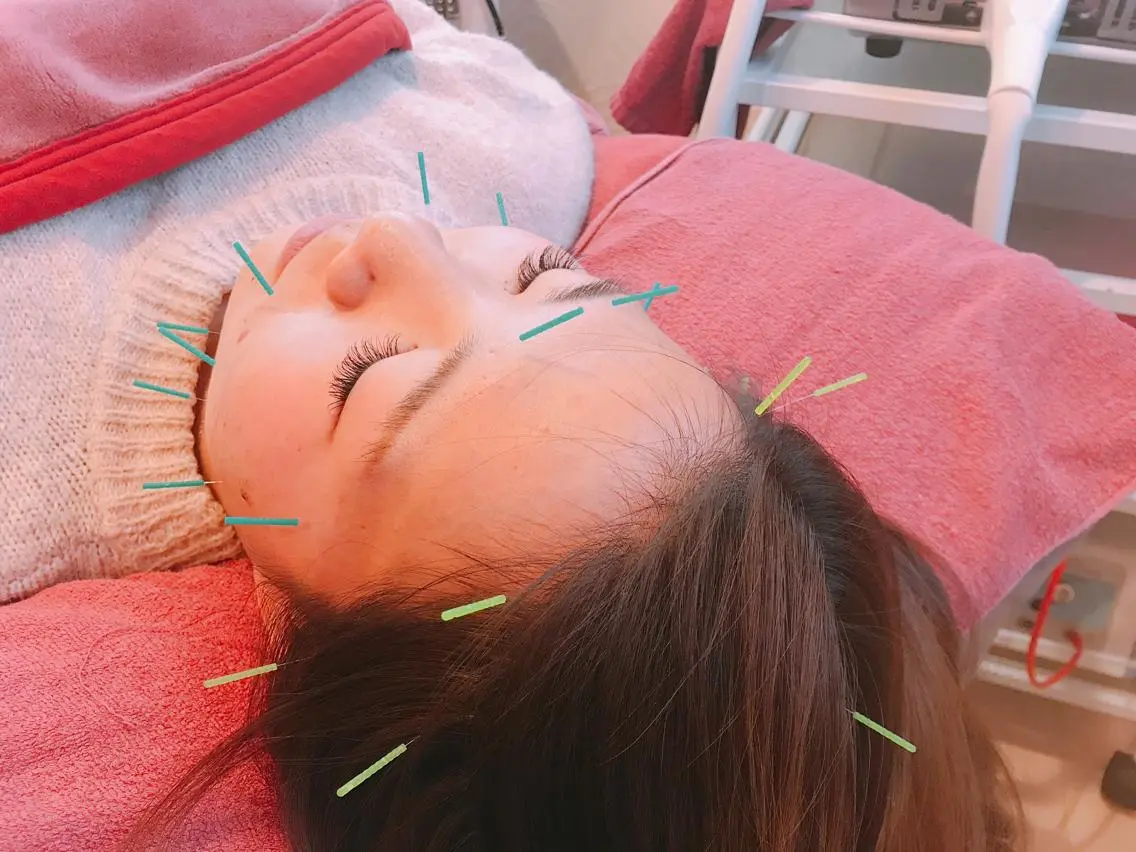 鍼のみ(2回目以降)の写真