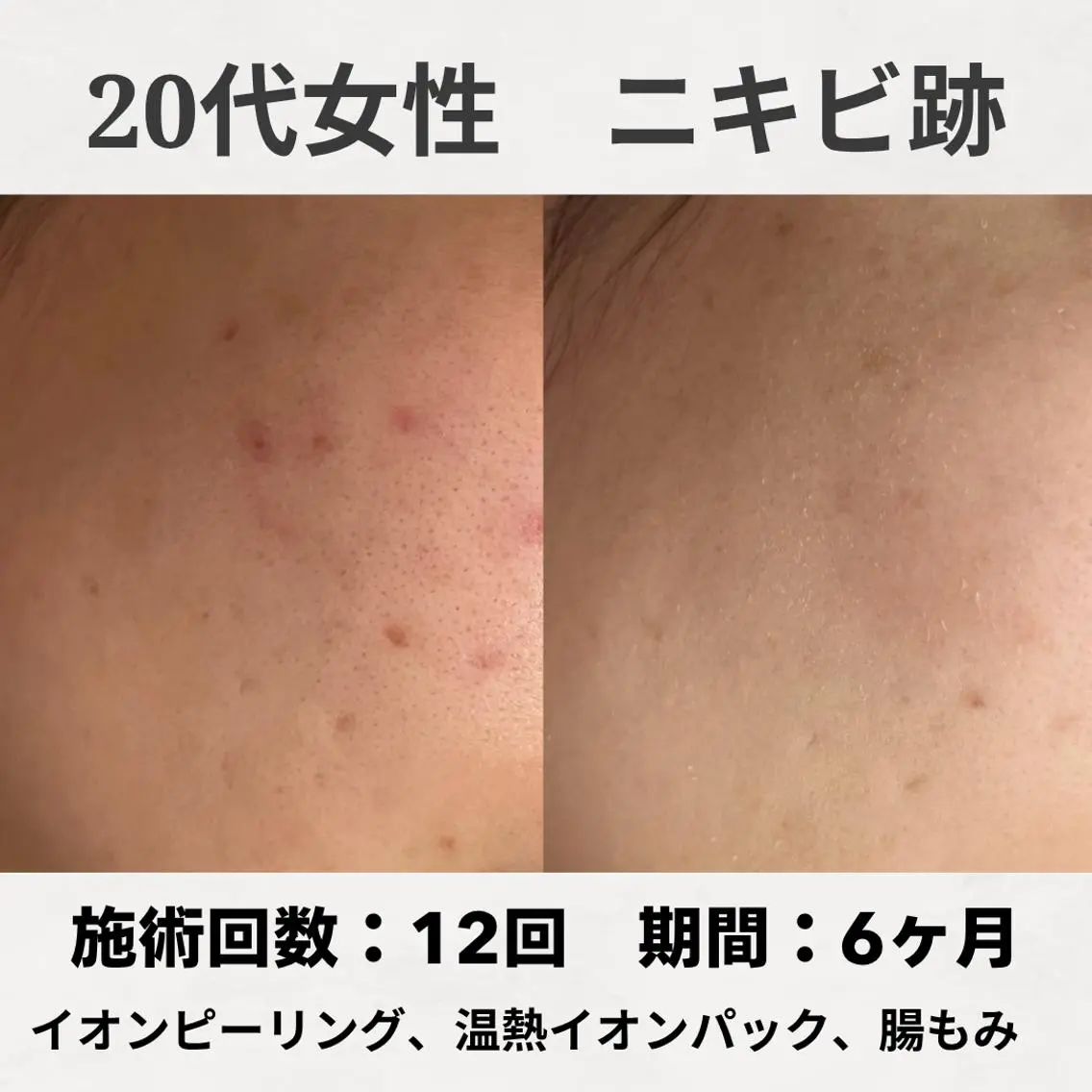 ニキビ跡改善専門🔥 医療にはできない改善のエステ・リラクイメージ
