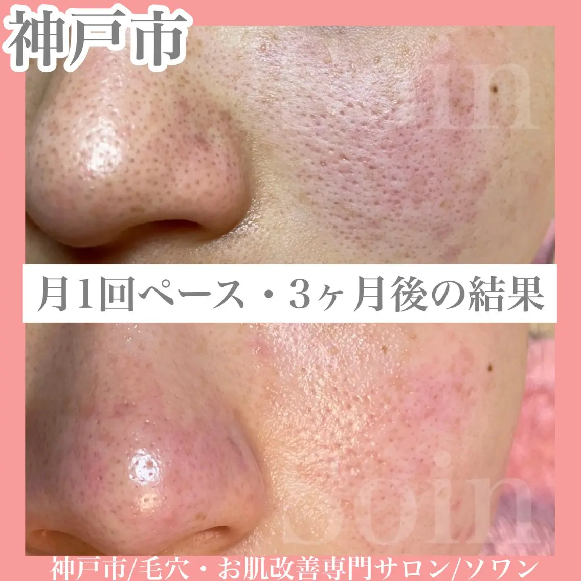 毛穴レス肌スペシャルコースの写真