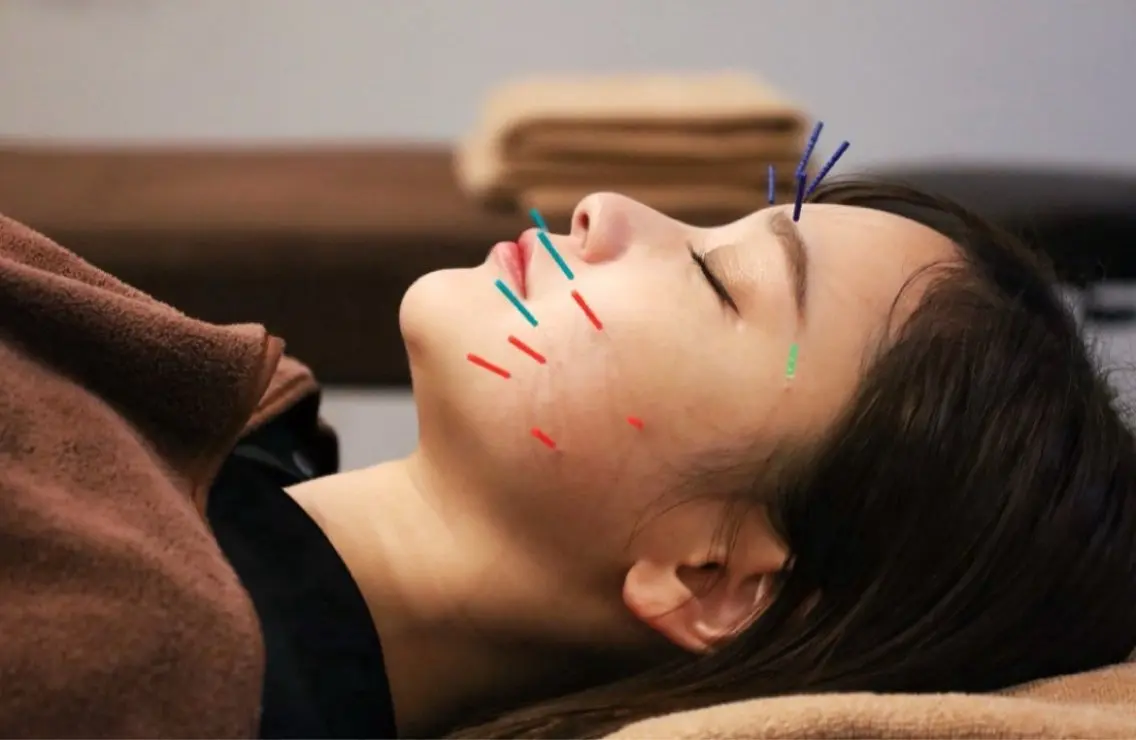 【美容鍼✨】むくみ撃退!小顔スイッチON💆♀️の写真