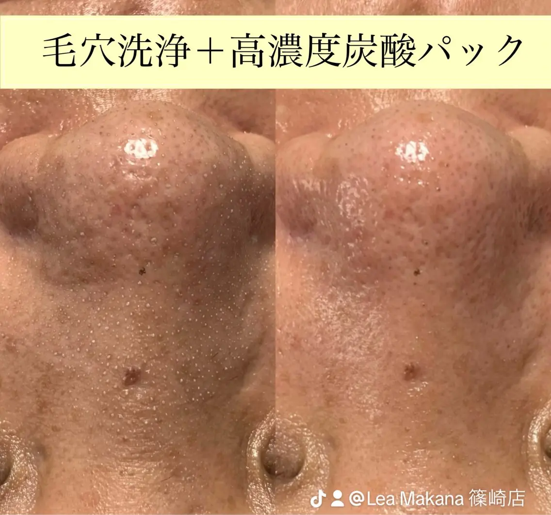 毛穴洗浄🍀脱毛🍀 光フェイシャル🍀のエステ・リラクイメージ
