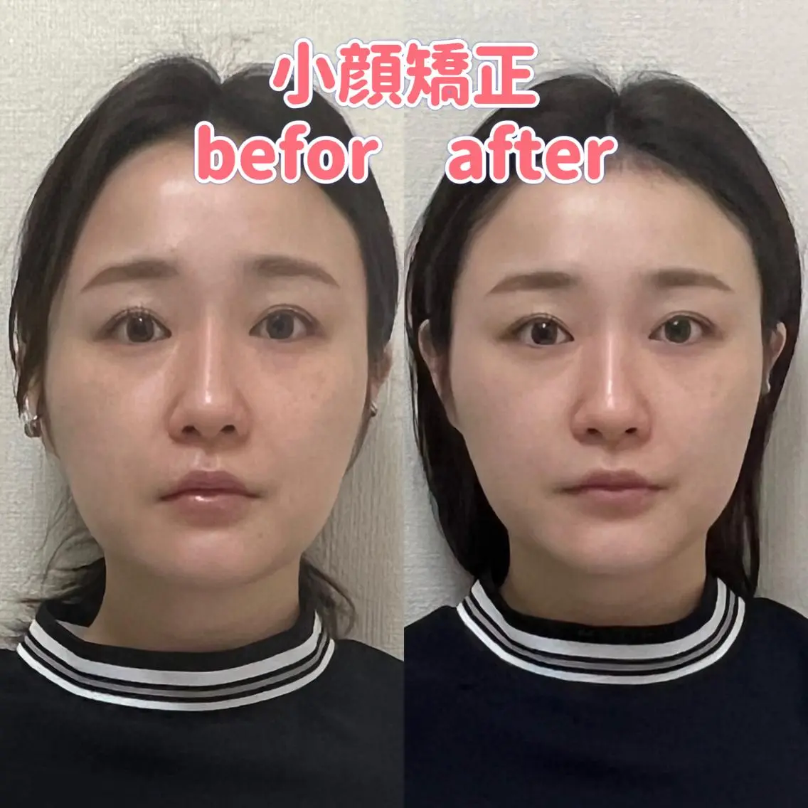 モニター募集‼️【小顔矯正】激変超人気の小顔矯正50分頭蓋骨から顔全体を調整する事での変化は、整形レベルです‼️の写真