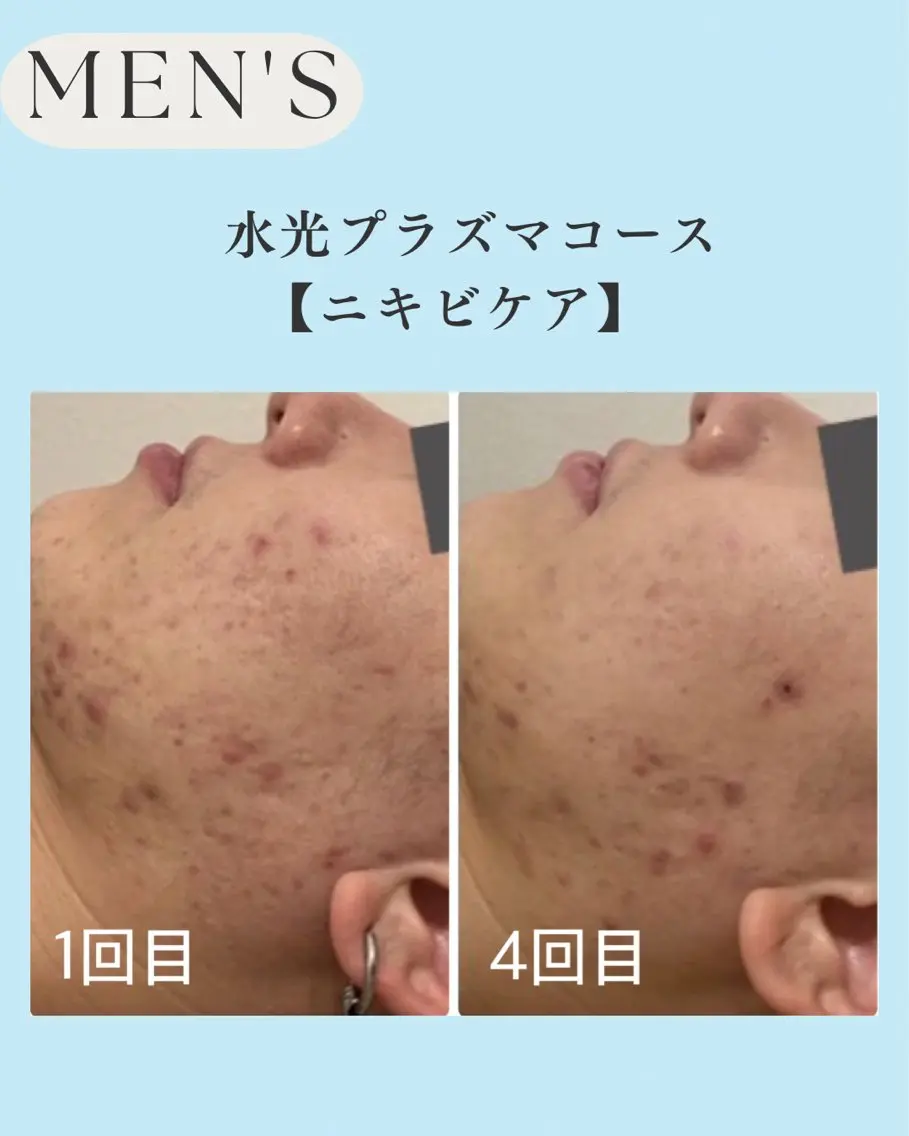 メンズ 小顔＆肌質改善 NICORIのエステ・リラクイメージ