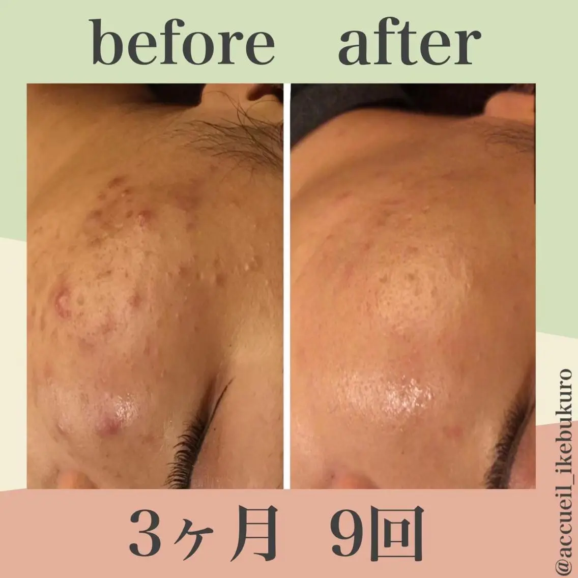 ミディアム カラー パーマ ヘアアレンジ ネイル マツエク・マツパ エステ リラク ニキビ・肌質改善専門 ♡人生が変わるサロンのエステ・リラクイメージ