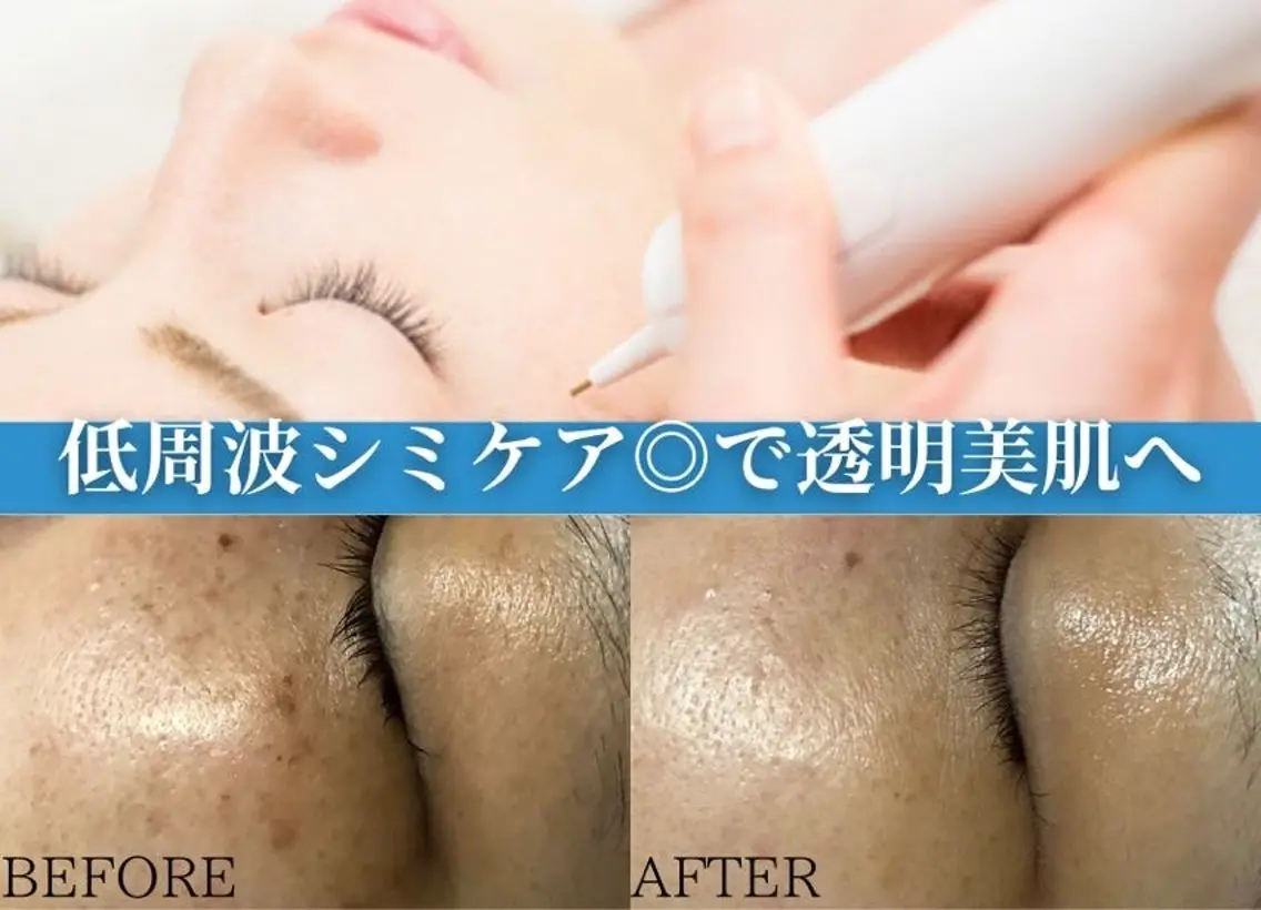 💎20分間シミ取り放題💎お肌に優しい低周波シミ取りで薄いシミも濃いシミも1週間でポロッと剥離◎の写真