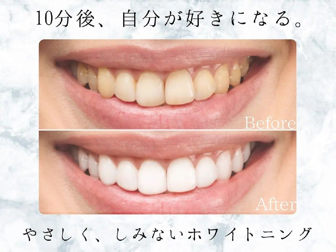 【お急ぎの方はこちら】最速プレミアムセルフホワイトニング (2来店60分照射)の写真