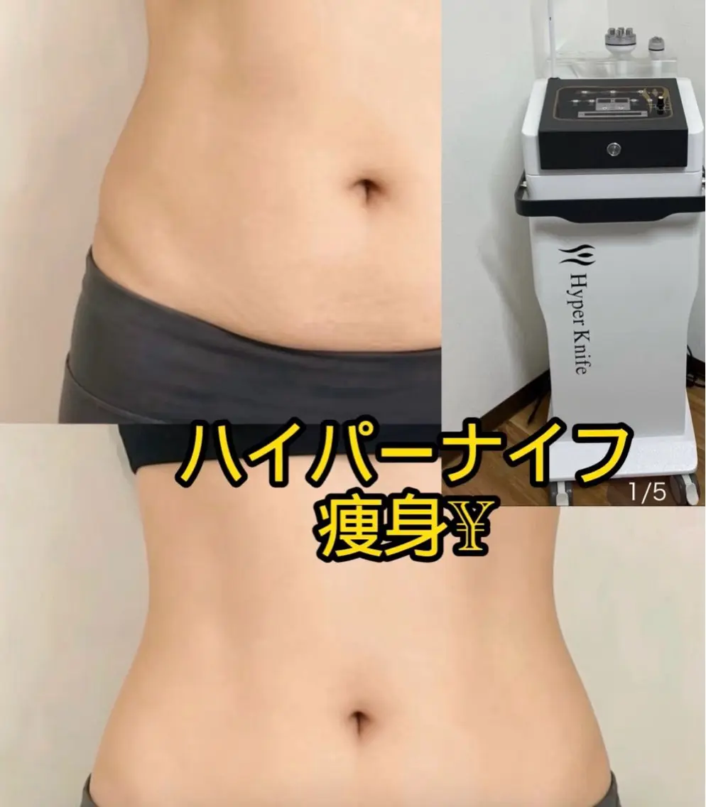 今だけ!超お得✨+ハイパーナイフー痩身セル脂肪に✨顔もOK!血行促進、コリとむくみ解消、冷え症✨80分¥7980の写真